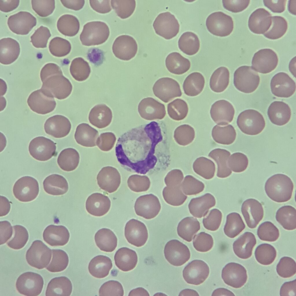 band neutrophil with vacuolization