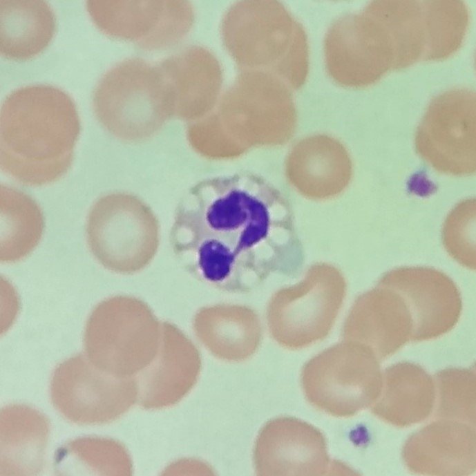 Neutrophil vacuolization