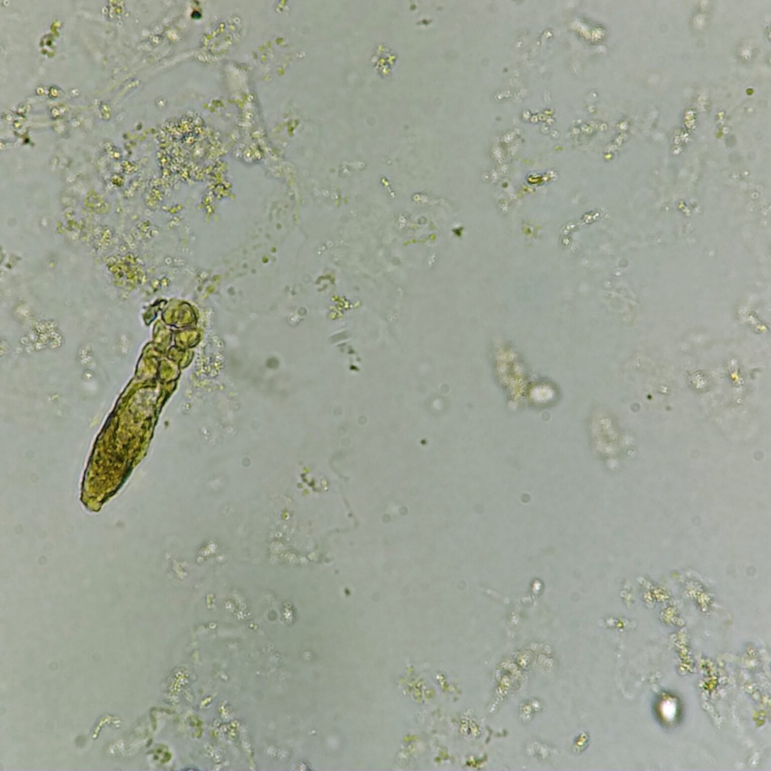 White Blood Cell Casts: Identification & Significance - MedLabBuddy