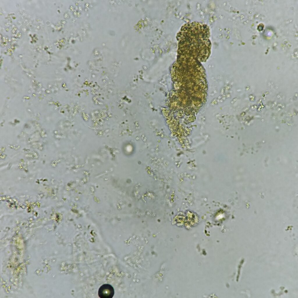 White Blood Cell Casts in Urine Sediment