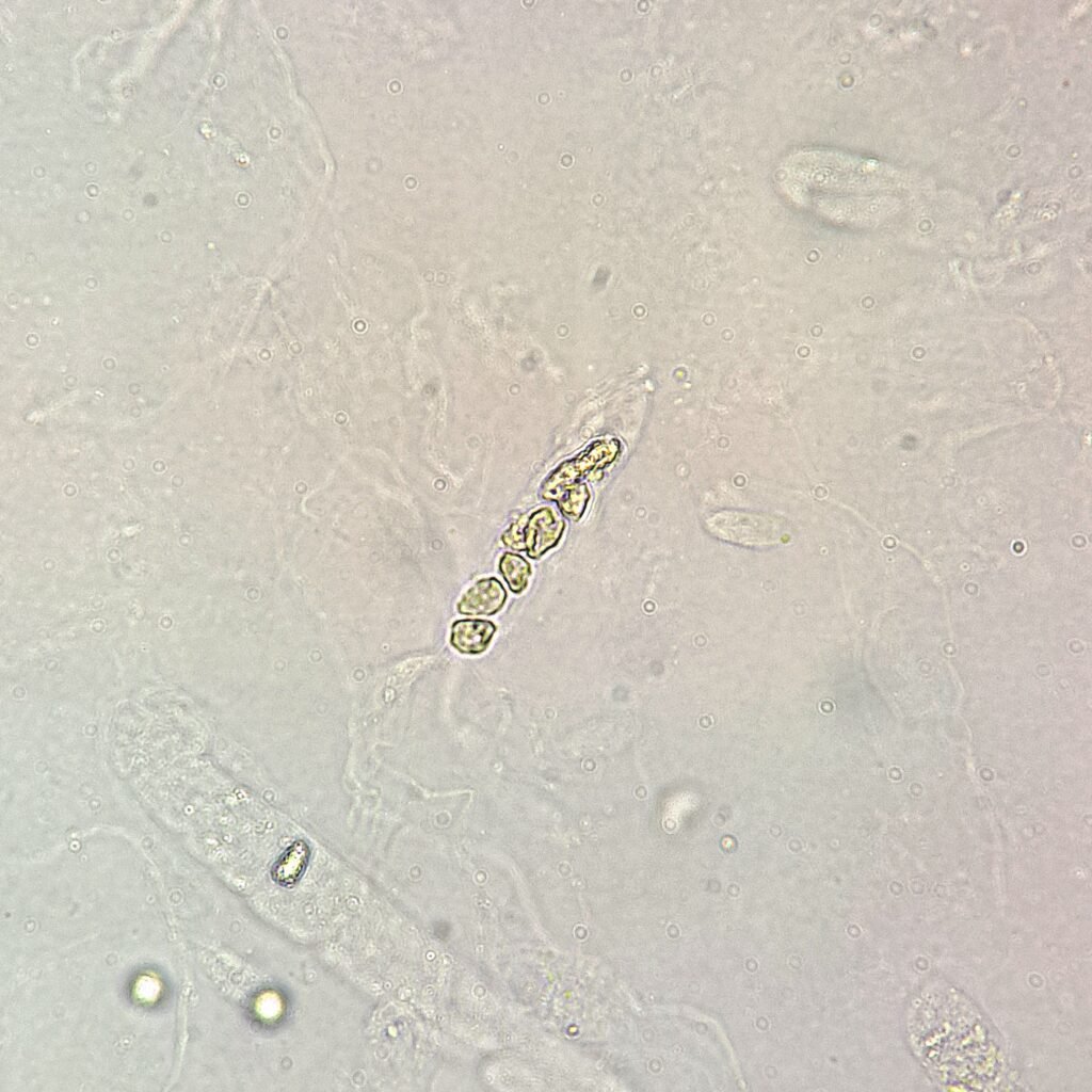 White Blood Cell Casts in Urine Sediment