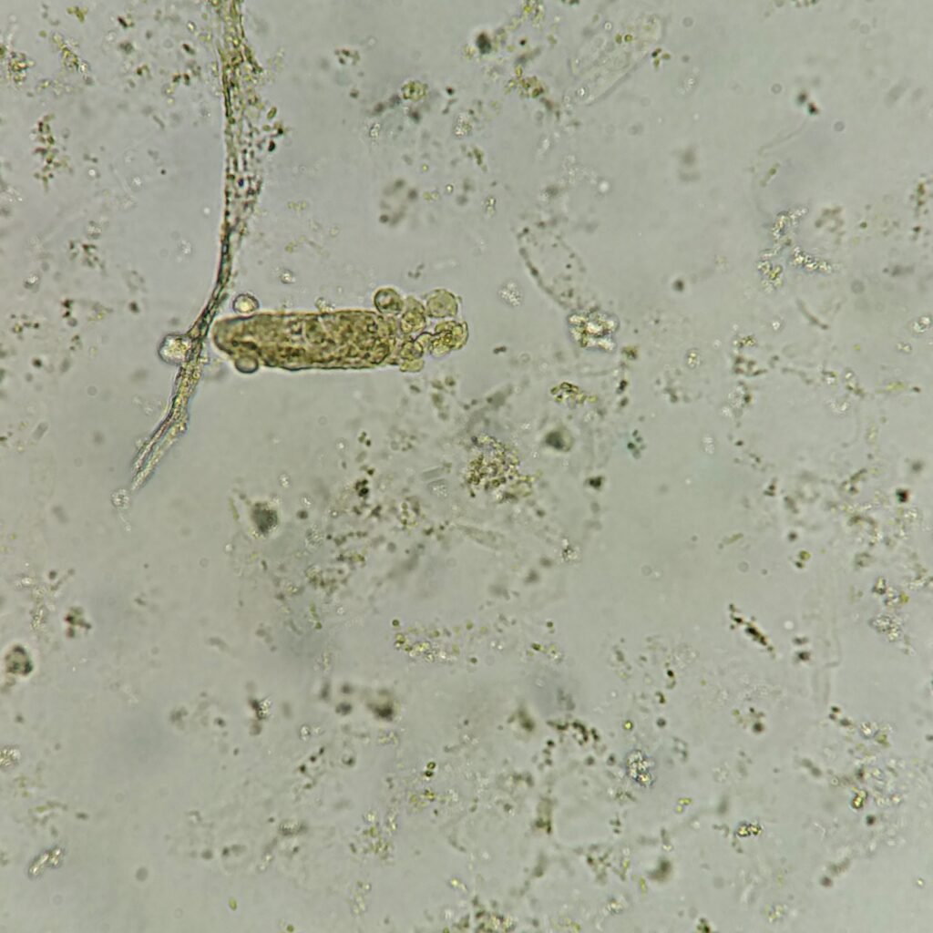 White Blood Cell Casts in Urine Sediment