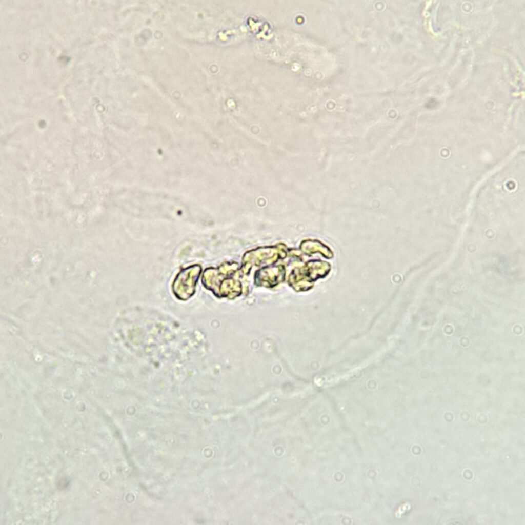 White Blood Cell Casts in Urine Sediment