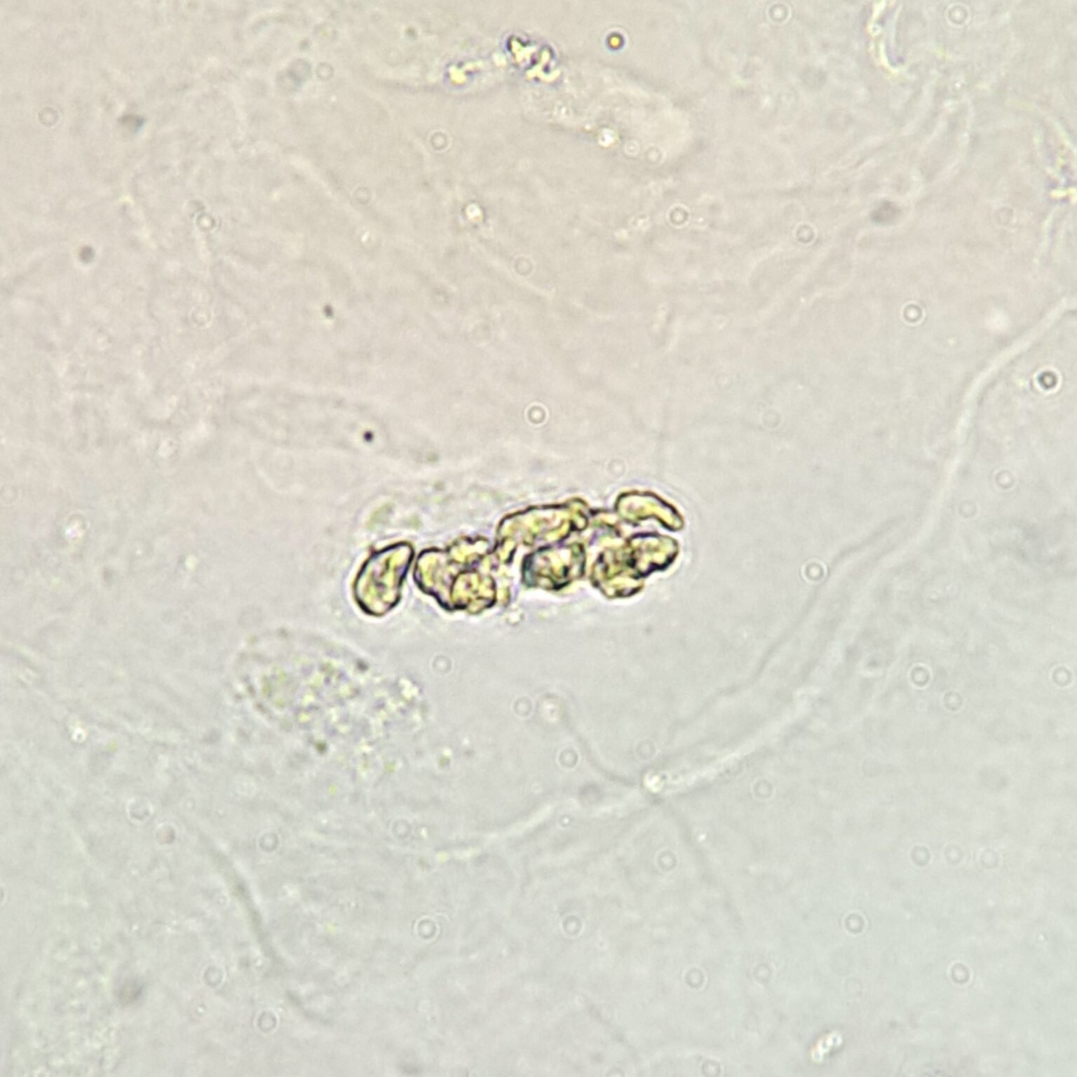 White Blood Cell Casts: Identification & Significance - MedLabBuddy