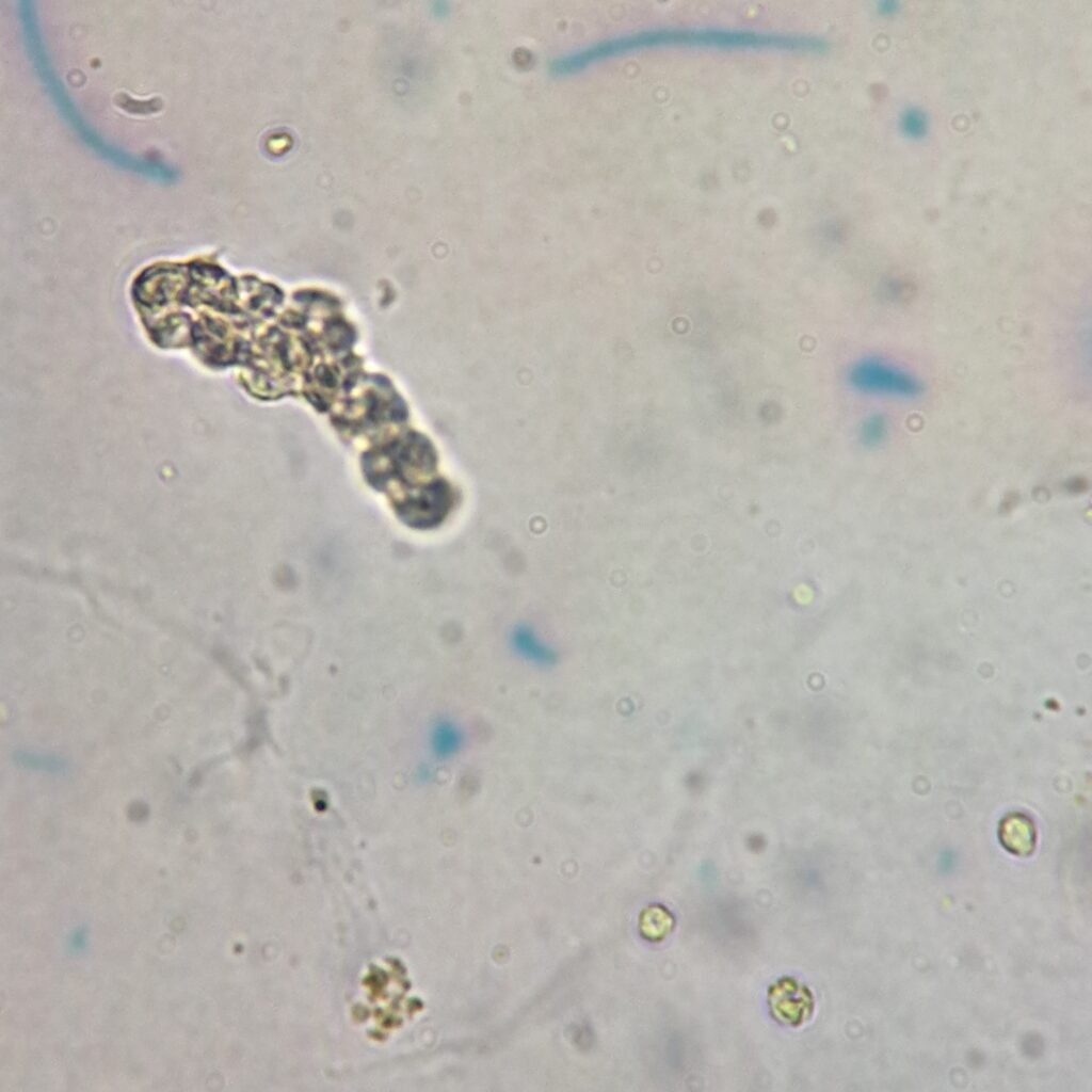 White Blood Cell Casts in Urine Sediment