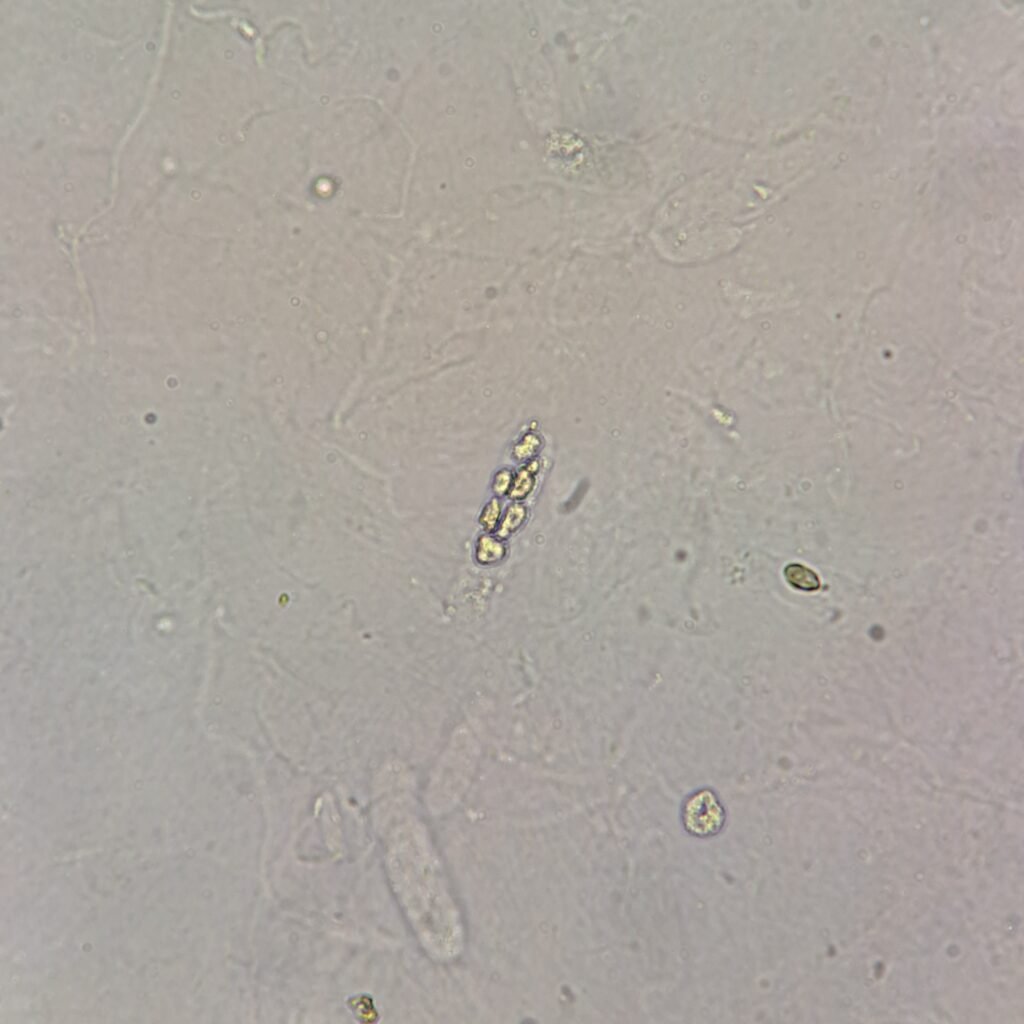 White Blood Cell Casts in Urine Sediment