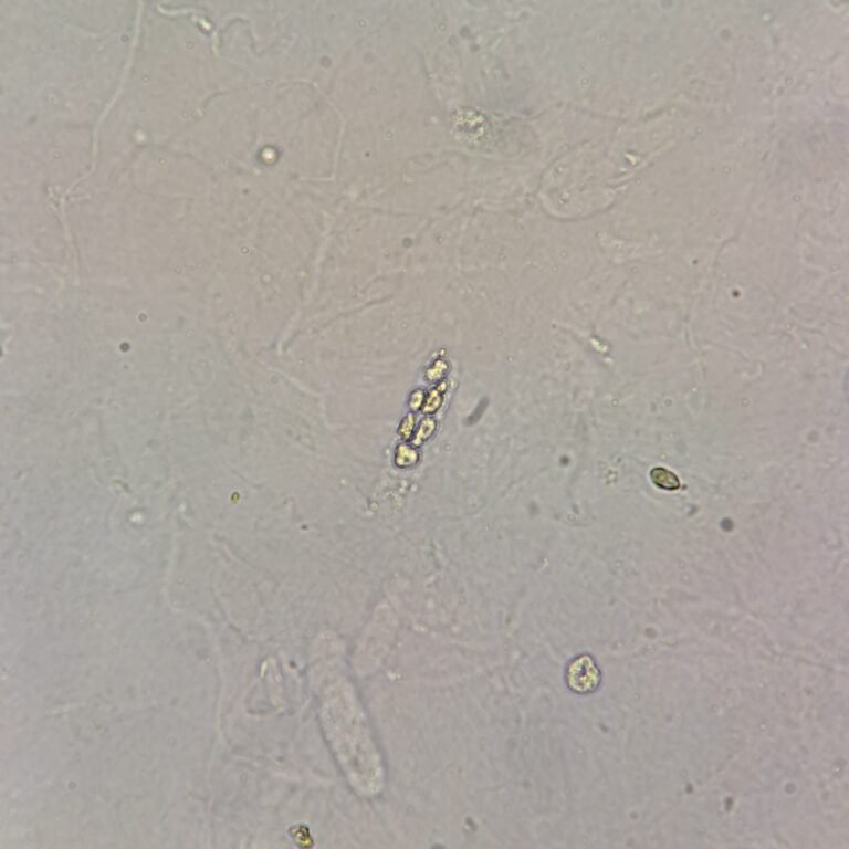 White Blood Cell Casts: Identification & Significance - MedLabBuddy