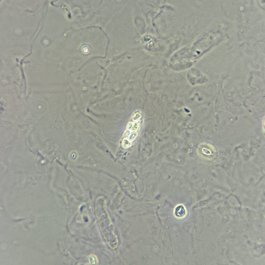 White Blood Cell Casts in Urine Sediment Under Phase Contrast