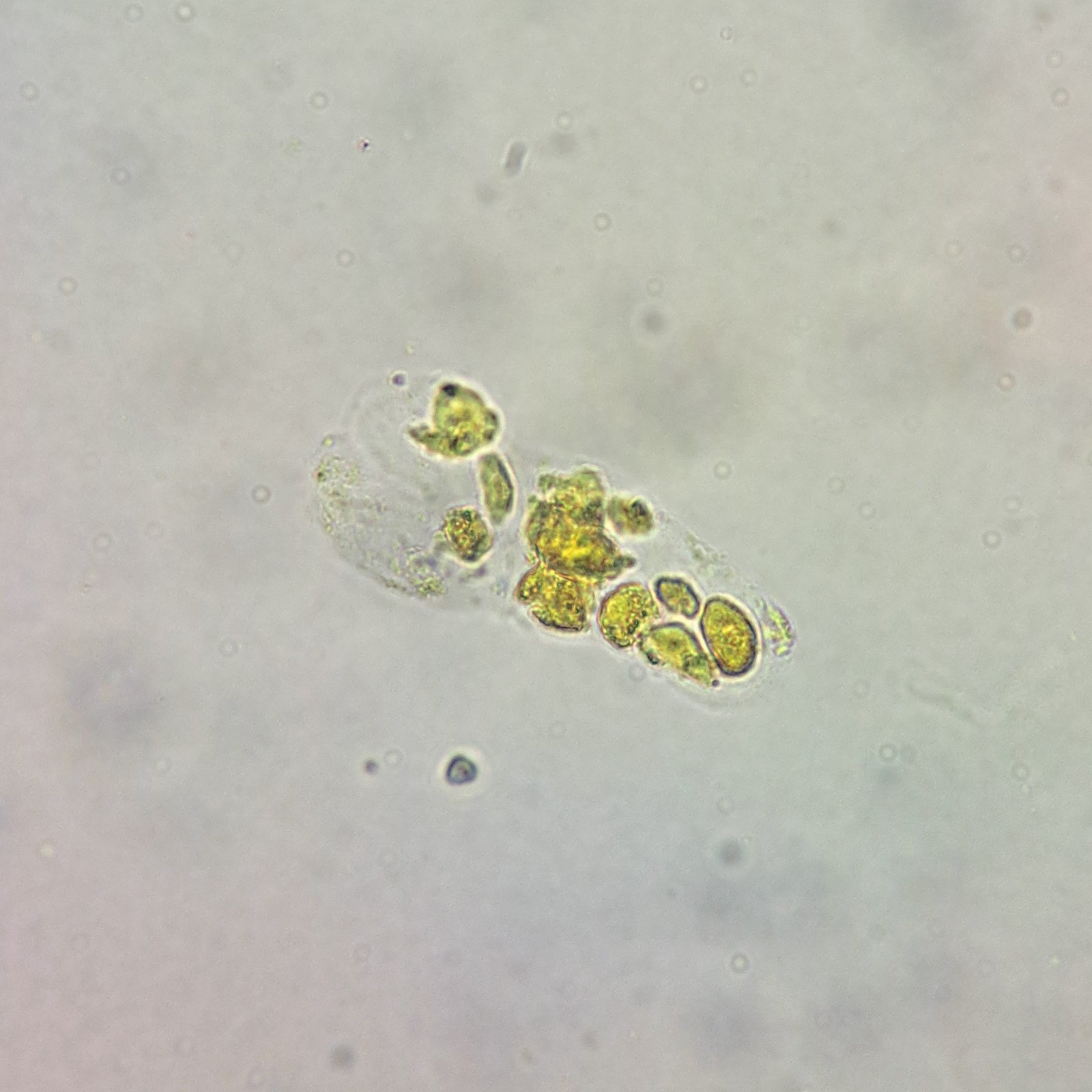 White Blood Cell Casts in Urine Sediment