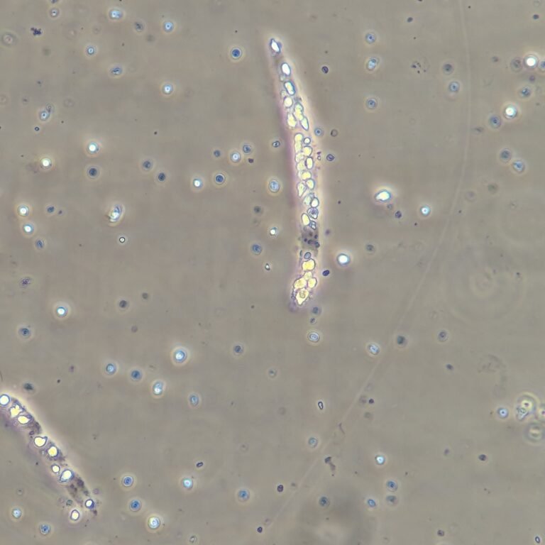 White Blood Cell Casts: Identification & Significance - MedLabBuddy