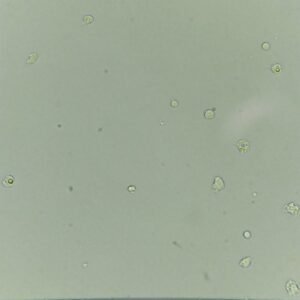 WBCs in Urine: Identification & Significance - MedLabBuddy