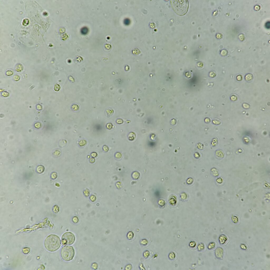white blood cells in urine
