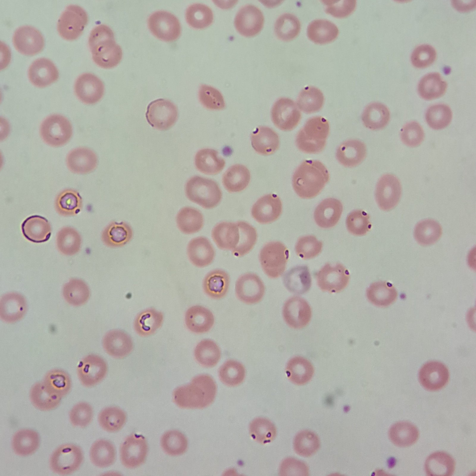 water artifact, red blood cell morphology