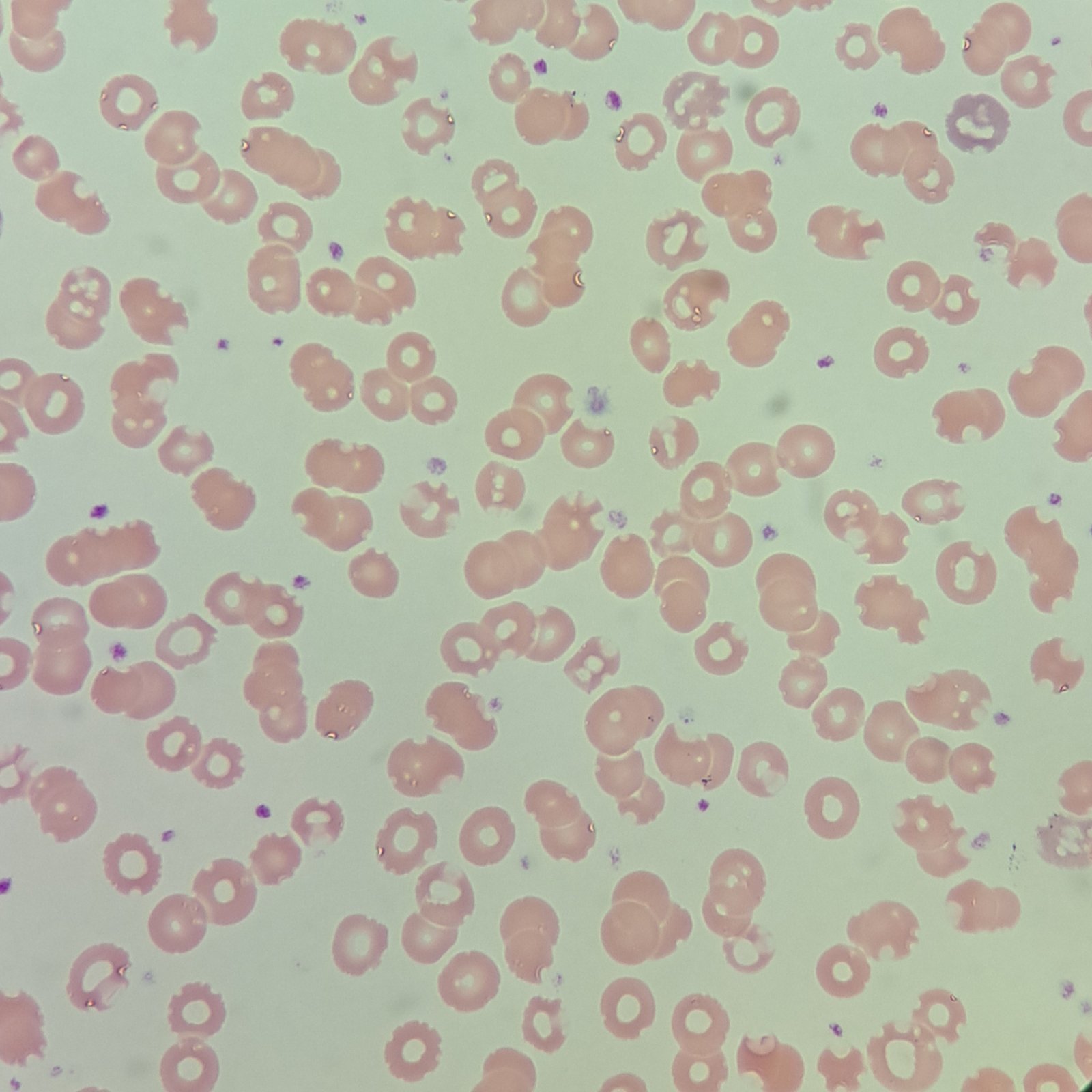 water artifact, red blood cell morphology