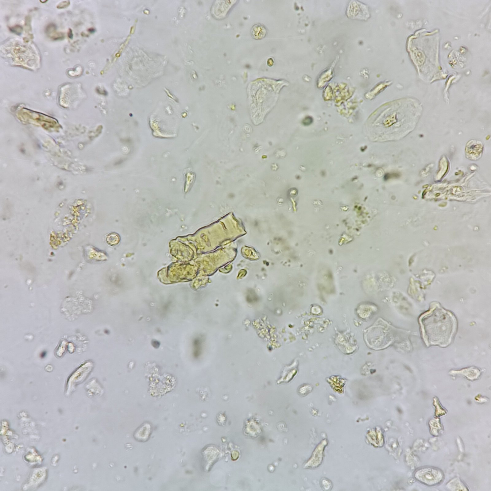Waxy Casts in Urine Sediment