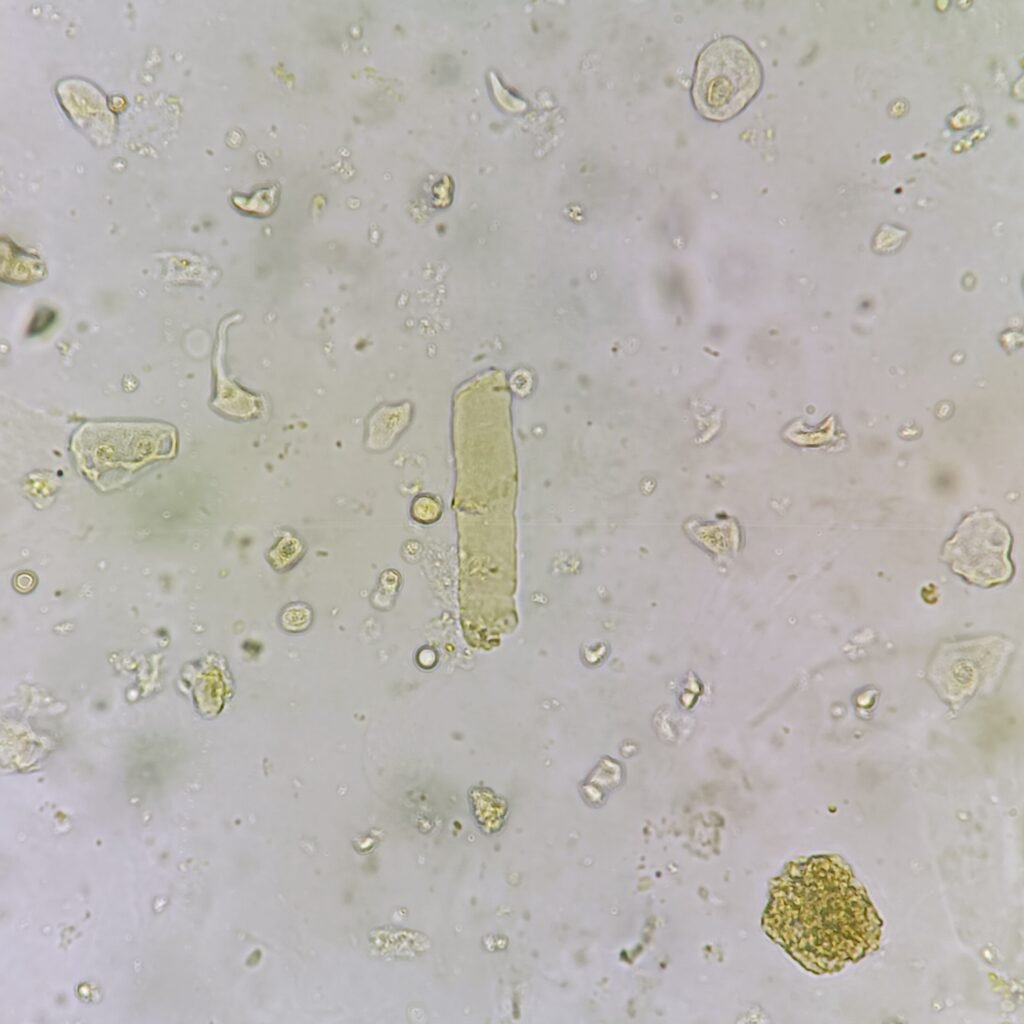 Waxy Cast in Urine Sediment