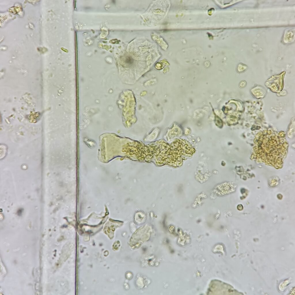 Waxy Cast in Urine Sediment