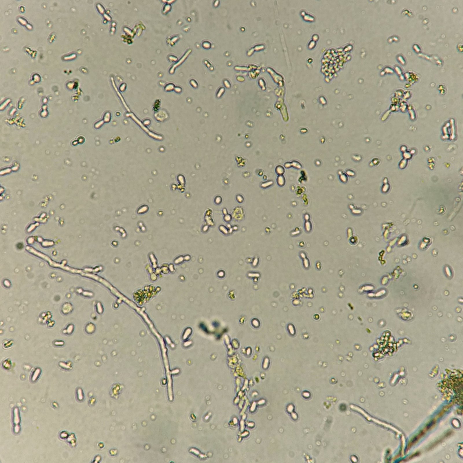 Budding & Hyphae Yeast in Urine