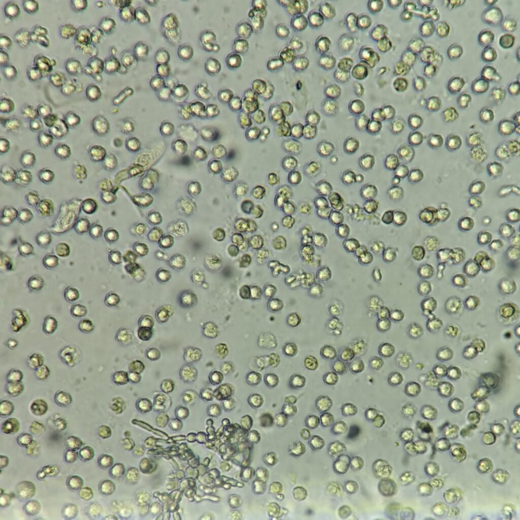 Budding Yeast in Urine