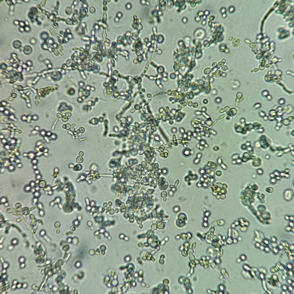 Budding & Hyphae Yeast in Urine