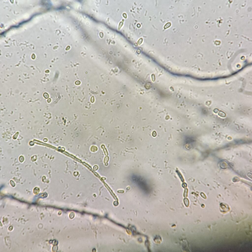 Budding & Hyphae Yeast in Urine