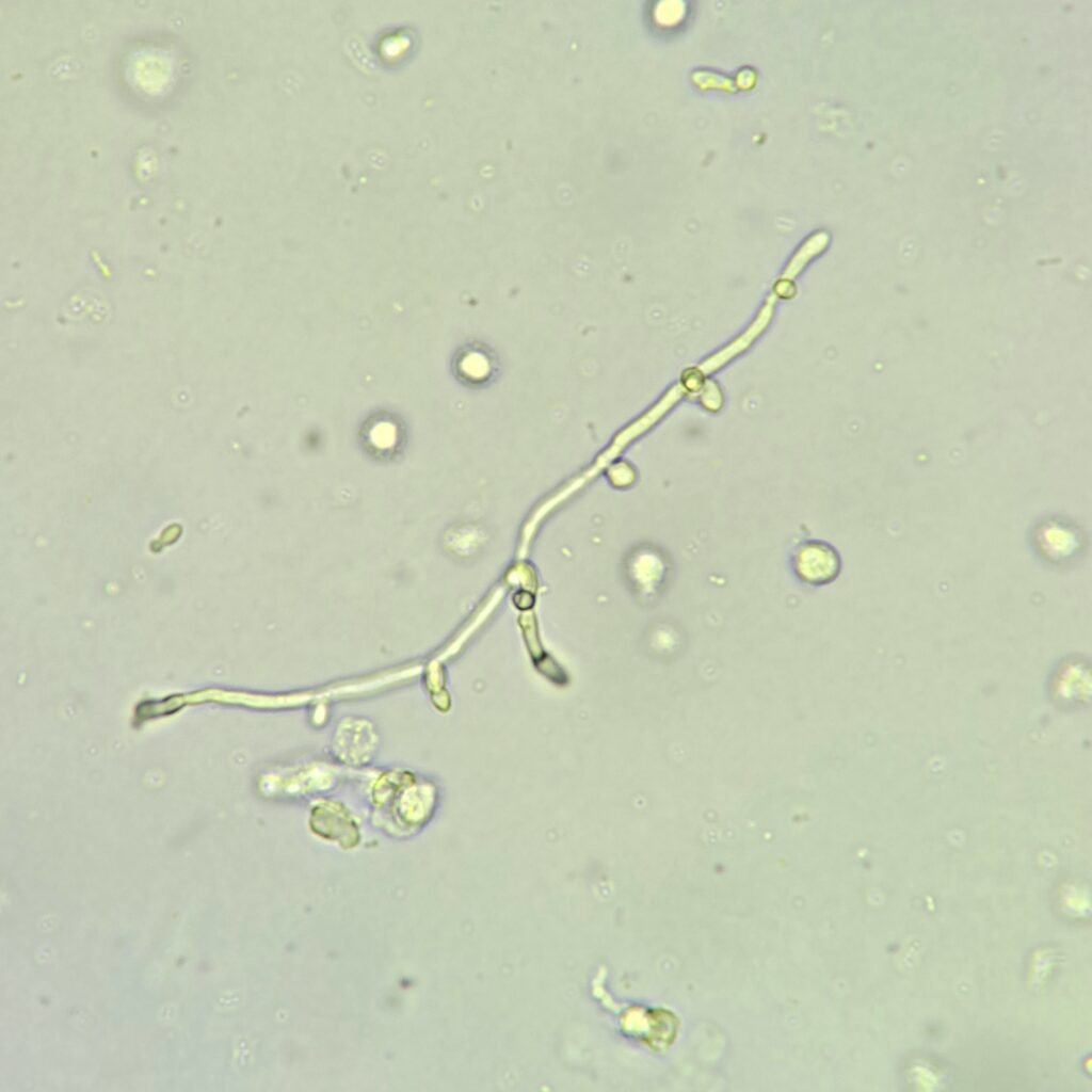 Hyphae Yeast in Urine