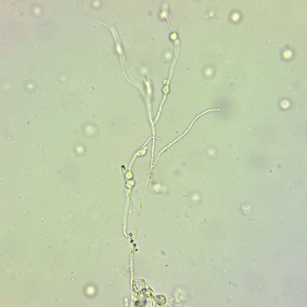 Hyphae Yeast in Urine