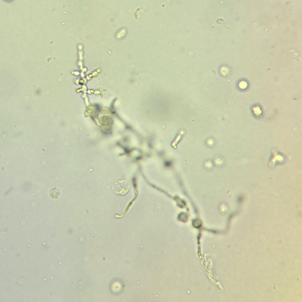 Budding & Hyphae Yeast in Urine