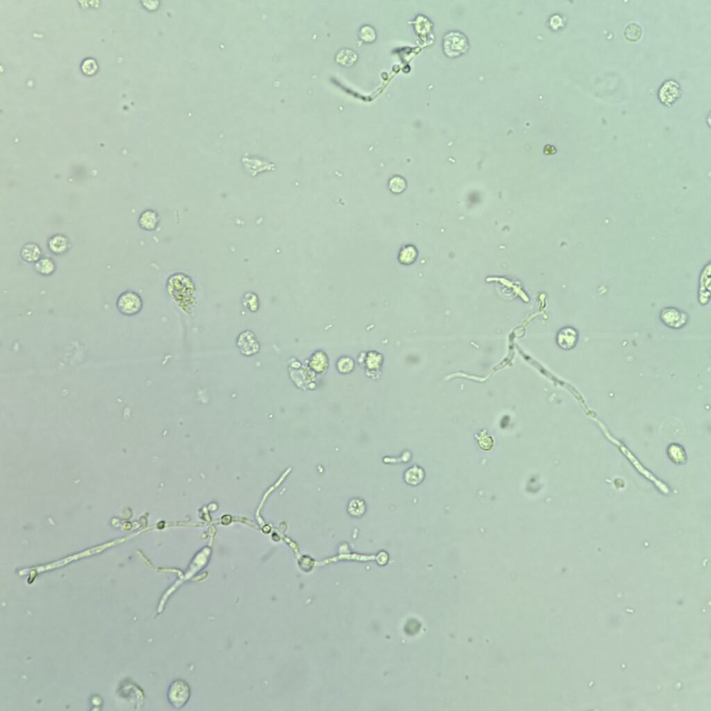 Budding & Hyphae Yeast in Urine