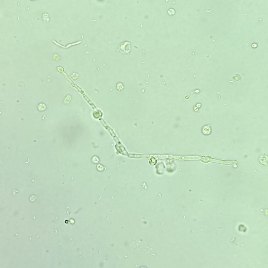 Hyphae Yeast in Urine