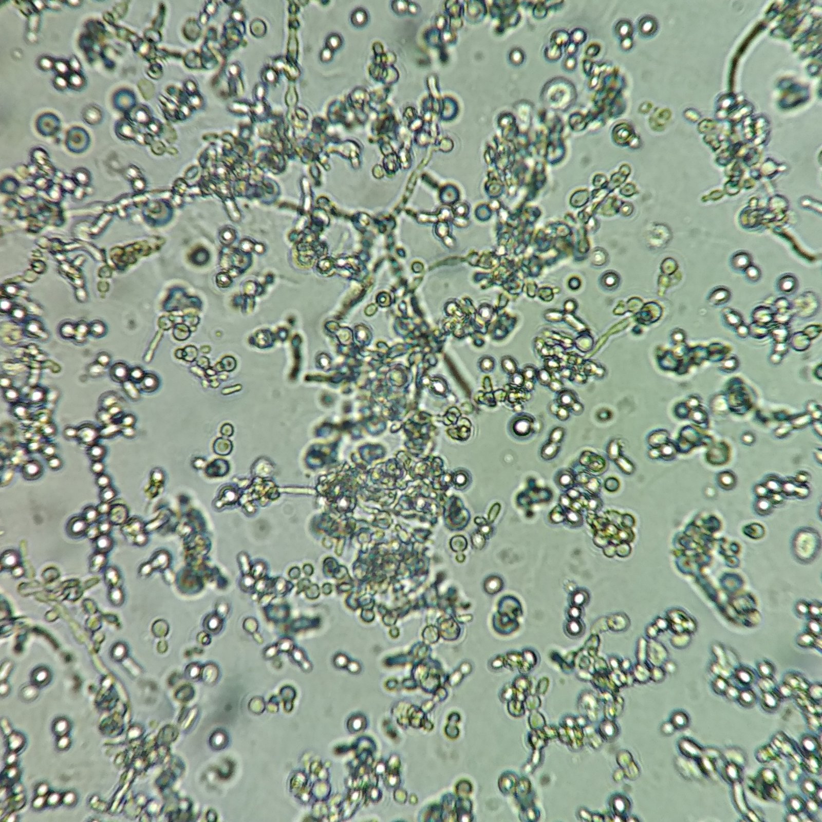 Yeast cells in urine sediment